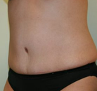  Bandingkan Sebelum & Sesudah Foto Tummy Tuck