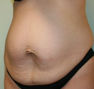  Bandingkan Sebelum & Sesudah Foto Tummy Tuck