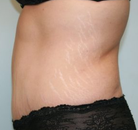  Bandingkan Sebelum & Sesudah Foto Tummy Tuck