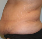  Bandingkan Sebelum & Sesudah Foto Tummy Tuck