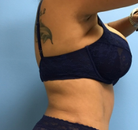  Bandingkan Sebelum & Sesudah Foto Tummy Tuck