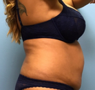  Bandingkan Sebelum & Sesudah Foto Tummy Tuck