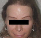  Bandingkan Sebelum & Sesudah Foto Operasi Penggantian Kelamin (Laki-Laki ke Perempuan)