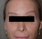  Bandingkan Sebelum & Sesudah Foto Operasi Penggantian Kelamin (Laki-Laki ke Perempuan)