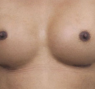  Bandingkan Sebelum & Sesudah Foto Operasi Penggantian Kelamin (Laki-Laki ke Perempuan)