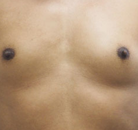  Bandingkan Sebelum & Sesudah Foto Operasi Penggantian Kelamin (Laki-Laki ke Perempuan)