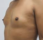  Bandingkan Sebelum & Sesudah Foto Operasi Penggantian Kelamin (Laki-Laki ke Perempuan)