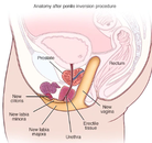  Bandingkan Sebelum & Sesudah Foto Operasi Penggantian Kelamin (Laki-Laki ke Perempuan)