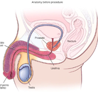  Bandingkan Sebelum & Sesudah Foto Operasi Penggantian Kelamin (Laki-Laki ke Perempuan)