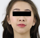  Bandingkan Sebelum & Sesudah Foto Operasi Penggantian Kelamin (Laki-Laki ke Perempuan)