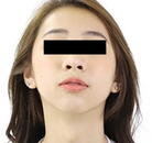  Bandingkan Sebelum & Sesudah Foto Operasi Penggantian Kelamin (Laki-Laki ke Perempuan)