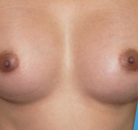  Bandingkan Sebelum & Sesudah Foto Operasi Penggantian Kelamin (Laki-Laki ke Perempuan)