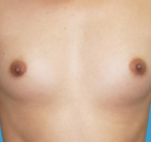  Bandingkan Sebelum & Sesudah Foto Operasi Penggantian Kelamin (Laki-Laki ke Perempuan)