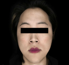  Bandingkan Sebelum & Sesudah Foto Operasi Penggantian Kelamin (Laki-Laki ke Perempuan)