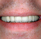 Bandingkan Sebelum & Sesudah Foto Implan Gigi