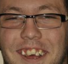 Bandingkan Sebelum & Sesudah Foto Implan Gigi