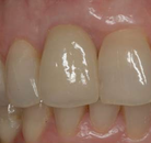 Bandingkan Sebelum & Sesudah Foto Implan Gigi