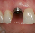 Bandingkan Sebelum & Sesudah Foto Implan Gigi