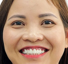 Bandingkan Sebelum & Sesudah Foto Implan Gigi