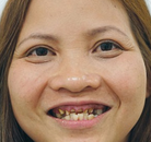 Bandingkan Sebelum & Sesudah Foto Implan Gigi