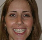 Bandingkan Sebelum & Sesudah Foto Implan Gigi