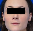  Bandingkan Sebelum & Sesudah Foto Operasi Feminisasi Wajah (FFS)