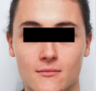  Bandingkan Sebelum & Sesudah Foto Operasi Feminisasi Wajah (FFS)