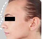  Bandingkan Sebelum & Sesudah Foto Operasi Feminisasi Wajah (FFS)