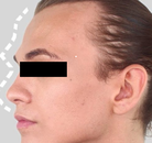  Bandingkan Sebelum & Sesudah Foto Operasi Feminisasi Wajah (FFS)