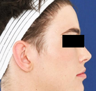  Bandingkan Sebelum & Sesudah Foto Operasi Feminisasi Wajah (FFS)