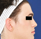  Bandingkan Sebelum & Sesudah Foto Operasi Feminisasi Wajah (FFS)