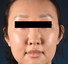  Bandingkan Sebelum & Sesudah Foto Operasi Feminisasi Wajah (FFS)