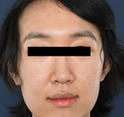  Bandingkan Sebelum & Sesudah Foto Operasi Feminisasi Wajah (FFS)