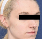  Bandingkan Sebelum & Sesudah Foto Operasi Feminisasi Wajah (FFS)