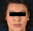  Bandingkan Sebelum & Sesudah Foto Operasi Feminisasi Wajah (FFS)