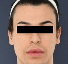  Bandingkan Sebelum & Sesudah Foto Operasi Feminisasi Wajah (FFS)