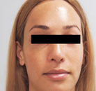  Bandingkan Sebelum & Sesudah Foto Operasi Feminisasi Wajah (FFS)