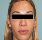  Bandingkan Sebelum & Sesudah Foto Operasi Feminisasi Wajah (FFS)