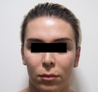  Bandingkan Sebelum & Sesudah Foto Operasi Feminisasi Wajah (FFS)