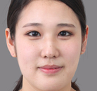  Bandingkan Sebelum & Sesudah Foto Pembuatan Kelopak Mata Ganda