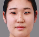  Bandingkan Sebelum & Sesudah Foto Pembuatan Kelopak Mata Ganda