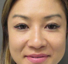  Bandingkan Sebelum & Sesudah Foto Pembuatan Kelopak Mata Ganda