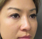  Bandingkan Sebelum & Sesudah Foto Pembuatan Kelopak Mata Ganda