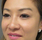  Bandingkan Sebelum & Sesudah Foto Pembuatan Kelopak Mata Ganda