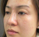  Bandingkan Sebelum & Sesudah Foto Pembuatan Kelopak Mata Ganda