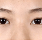  Bandingkan Sebelum & Sesudah Foto Pembuatan Kelopak Mata Ganda