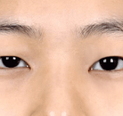  Bandingkan Sebelum & Sesudah Foto Pembuatan Kelopak Mata Ganda