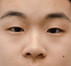  Bandingkan Sebelum & Sesudah Foto Pembuatan Kelopak Mata Ganda