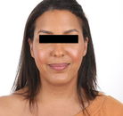 Bandingkan Sebelum & Sesudah Foto Operasi Penurunan Garis Rambut