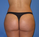 Bandingkan Sebelum & Sesudah Foto Brazilian Butt Lift